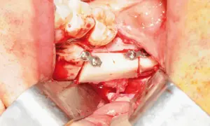Chirurgia orale: frammento osseo fissato con placche metalliche, vicino al nervo alveolare.