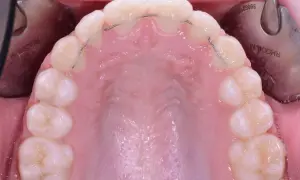 Filo contenzione denti: un sottile filo metallico applicato dietro gli incisivi per mantenere l'allineamento. Il costo varia.