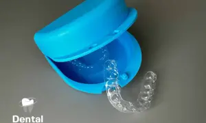 Apparecchio trasparente per correggere la malocclusione 1 classe. Custodia blu aperta con un bite all'interno.