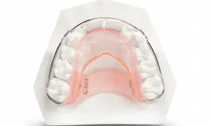 Modello di un elevatore linguale notturno su un calco dentale, progettato per correggere la posizione dei denti durante il sonno.