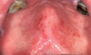 Palato con arrossamento diffuso e numerosi puntini rossi, possibili segni di candida.