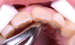Dettaglio di un apparecchio ortodontico che lavora sullo spazio tra i denti laterali, con cotone per isolare.