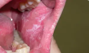 Bocca con leucoplachia, macchie bianche sulla mucosa interna. La buona notizia è che la leucoplachia si guarisce con le giuste cure.