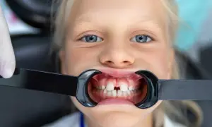 Bambina con diastema, in attesa di apparecchio ortodontico, sorride dal dentista.