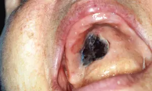 Lesione scura e irregolare sul palato, sospetto melanoma orale.
