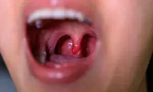 Bocca aperta mostra tonsille arrossate e infiammate, sintomo di mucosite da chemioterapia. Si cercano rimedi naturali.