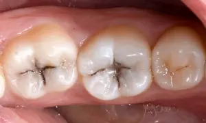 Denti con evidenti segni di carie, con aree scure e profonde che indicano un dente cariato.