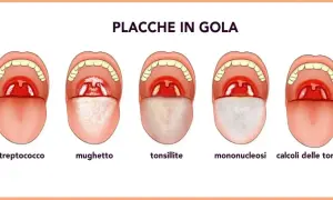 Illustrazione di diverse condizioni della gola, tra cui placche, mughetto e tonsillite, utili per comprendere i rimedi naturali per le placche in gola.