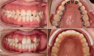 Denti con agenesia e apparecchio ortodontico. Valutare i costi per risolvere l'agenesia dentale.