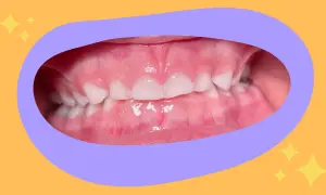 Primo piano dei denti di un bambino con un morso aperto, mostrando gli incisivi superiori e inferiori separati.