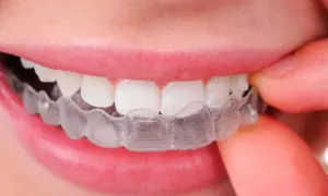 Denti allineati con Invisalign, una scelta discreta anche in gravidanza per un sorriso perfetto.