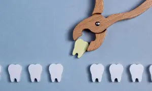 Pinze in legno estraggono un dente giallo da una fila di denti bianchi. Simboleggia la guarigione dopo l'estrazione del dente.