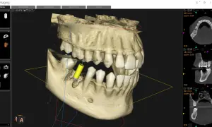 Visualizzazione 3D di un impianto dentale tramite cbct dentale. Sezioni assiali, coronali e sagittali mostrano dettagli ossei e dentali.