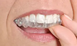 Dita che rimuovono un apparecchio trasparente, mostrando come togliere Invisalign per una pulizia rapida.
