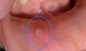 Una piccola afte con filamenti bianchi in bocca, evidenziata da un cerchio blu, appare sulla mucosa interna della guancia.