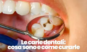 Dettaglio di denti con carie visibile in uno specchietto dentale. Scopri cosa sono le carie e come curare una carie a casa.