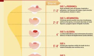 Le fasi dell'herpes labiale: dalla fase prodromica (1-2 giorni) all'ulcera e alla guarigione (fino a 12 giorni).