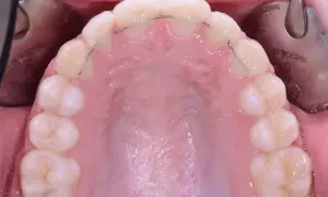 Denti dopo apparecchio con filo metallico di ritenzione. Un sorriso perfetto è il risultato di cure attente.