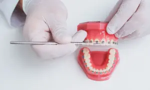 Modello di denti con apparecchio, per correggere denti storti adulti.