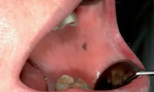 Piccolo neo scuro sulla mucosa interna della guancia, una lesione pigmentata da monitorare.