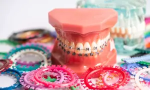 Modello di denti con apparecchio ortodontico, che ricorda l'apparecchio denti anni 80, circondato da elastici colorati.