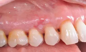 Gengiva con lesione biancastra, possibile leucoplachia villosa, vicino ai denti.