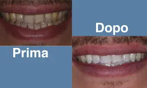 Prima: denti ingialliti con apparecchio fisso trasparente. Dopo: sorriso smagliante con denti bianchi e perfetti.