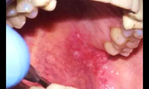 Lingua infiammata con lesioni, strumento medico vicino. La biopsia lingua è dolorosa.