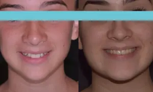 Prima e dopo: un sorriso più armonioso con una mascella pronunciata che valorizza il volto.