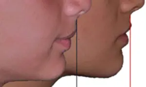 Confronto profili: un morso profondo nel viso evidenziato da linee guida.