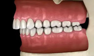 Vista laterale di denti con malocclusione dentale, i denti superiori sporgono notevolmente su quelli inferiori, un sintomo comune.