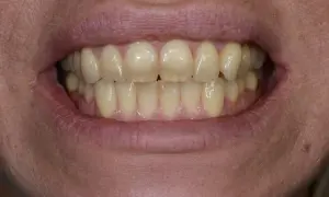 Denti ingialliti, forse a causa della clorexidina. La bocca è aperta, mostrando un sorriso.