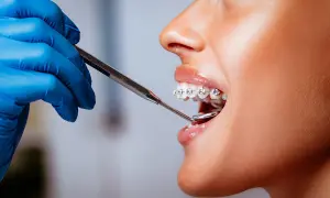 Primo piano di una bocca con apparecchio, mentre un dentista con guanto blu esamina i denti per raddrizzare i denti.