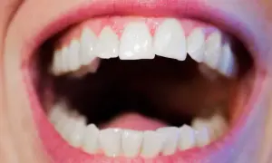 Bocca aperta con denti bianchi e ravvicinati, un esempio di affollamento dentale.
