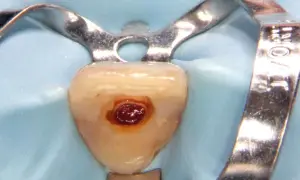 Dettaglio di un dente con cavità preparata per il cemento radicolare, isolato con diga di gomma e clamp metallico.