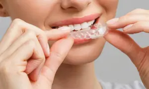Sorriso smagliante con mascherine denti prima e dopo. La trasparenza delle mascherine invisibili per un sorriso perfetto.