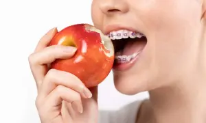 Mentre si morde una mela rossa, si vedono i denti con l'apparecchio. Un esempio di cosa mangiare con l'apparecchio, con cautela.