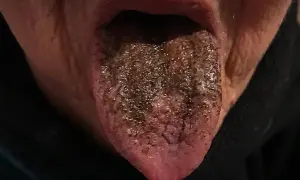 Lingua marrone, forse per cause legate all'alimentazione o a farmaci, appare ricoperta da una patina scura e granulosa.