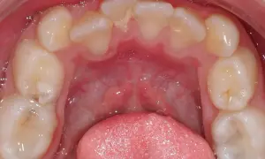 Vista ravvicinata dell'arcata dentale inferiore con evidente affollamento dentale inferiore. Si notano denti leggermente storti e sovrapposti.
