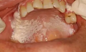 Leucoplachia palato: placche biancastre e irregolari sul palato, con aree rosse e puntini.