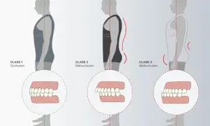 Illustrazione della classificazione di angle: Class 1 (occlusione corretta), Class 2 e Class 3 (malocclusioni) con dettagli dentali.