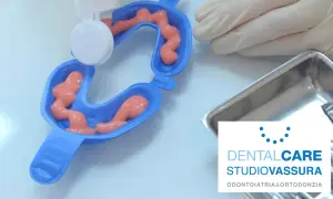 Applicazione di gel per fluoro profilassi in un portaimpronte dentale.