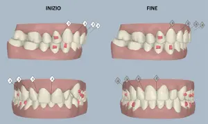 Confronto tra denti prima e dopo il trattamento ortodontico, con evidenziati gli attachment Invisalign.