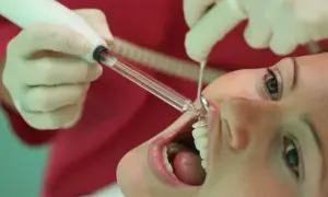Trattamento dentale con ozono. Un dentista usa uno strumento per applicare il gel ozono sui denti di una paziente.