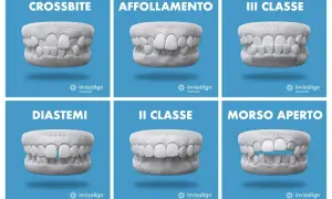 Sei casi di malocclusione dentale: crossbite, affollamento, III classe, diastemi, II classe, morso aperto. Soluzioni con mascherine invisalign.