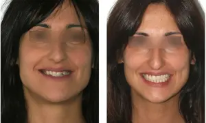 Sorriso prima e dopo: miglioramento estetico del canino incluso e dei denti.