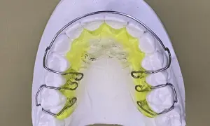 Modello di gesso con una placca di Hawley colorata di giallo, pronta per correggere l'allineamento dentale.
