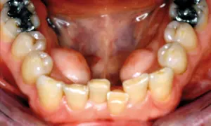 Vista ravvicinata della bocca con denti inferiori e superiori visibili. Si nota una piccola protuberanza carnosa, forse un'esostosi, sulla gengiva.