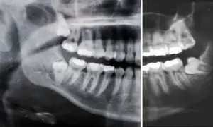 Radiografia panoramica mostra un dente incluso, probabilmente un molare, intrappolato nell'osso mascellare, impedendone la corretta eruzione.
