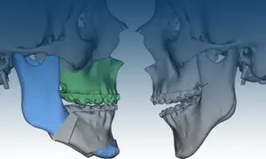 Modellazione 3D di un intervento maxillo-facciale per correggere una terza classe, evidenziando le aree di osteotomia e i potenziali rischi.